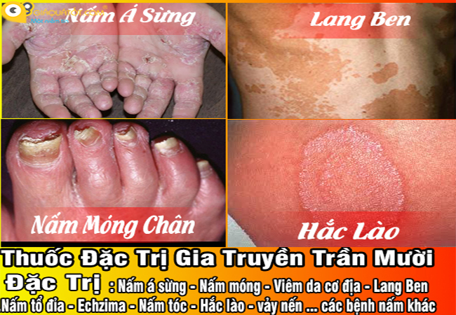 Địa chỉ mua thuốc đặc trị nấm Trần Mười chính hãng nhất